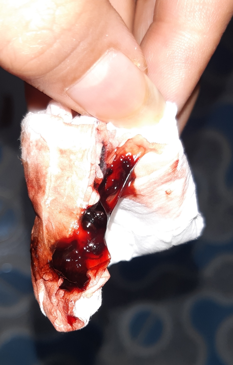 سلام دکتر و دوستان توروخدا زود جوابمو بدید لطفا😭خونریزی بعد از سونو واژینال سلام دکتر و دوستان توروخدا زود جوابمو بدید لطفا😭خونریزی بعد از سونو واژینال