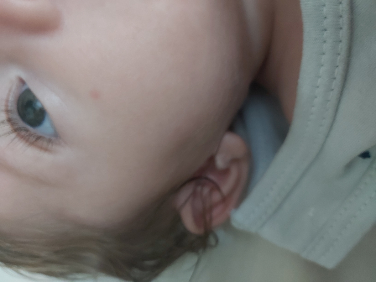 حساسیت نوزاد ب موز حساسیت نوزاد ب موز