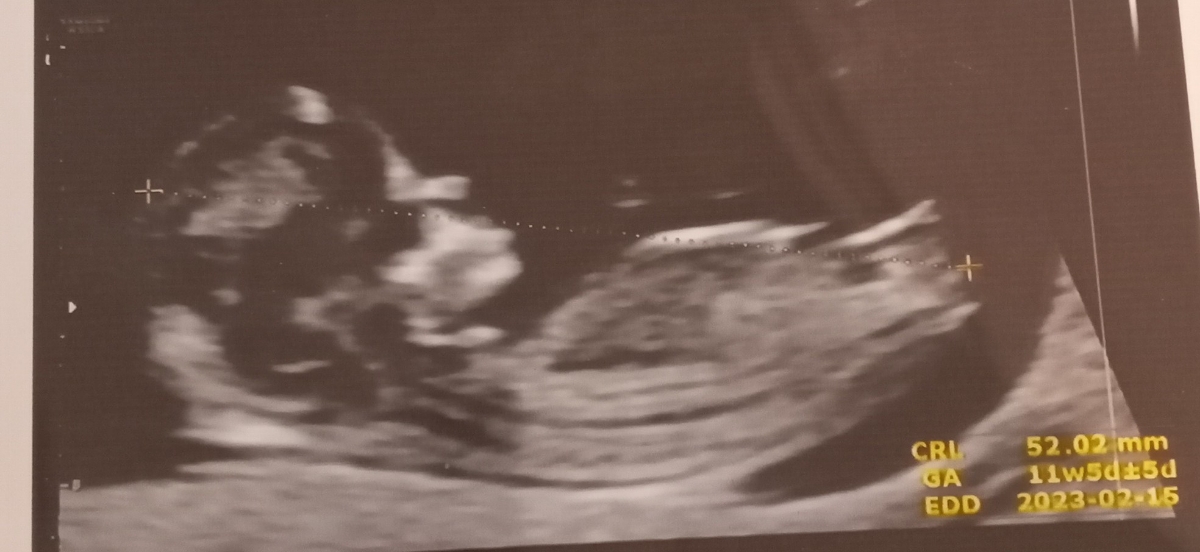 زمان مناسب سونوگرافی غربالگری دوم؟