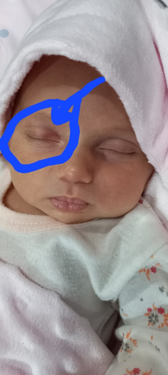 اینم قرمزی روی چشمش