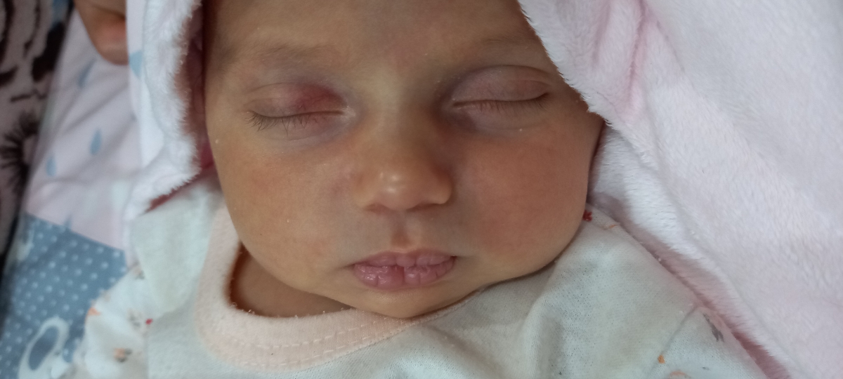 علت نقطه های سفید روی صورت نوزاد