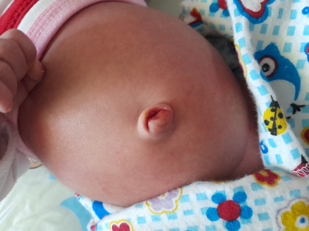 خون امدن از ناف