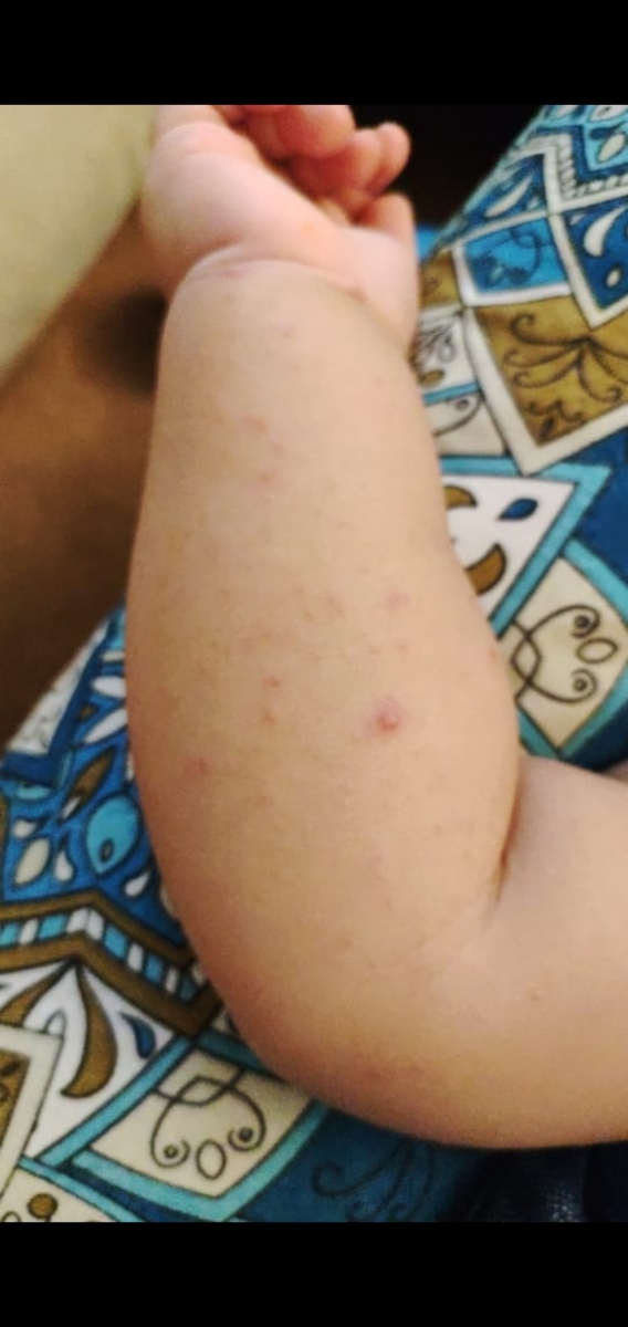 تب زیاد نوزاد ۸ ماه ۱۱ روز تب زیاد نوزاد ۸ ماه ۱۱ روز