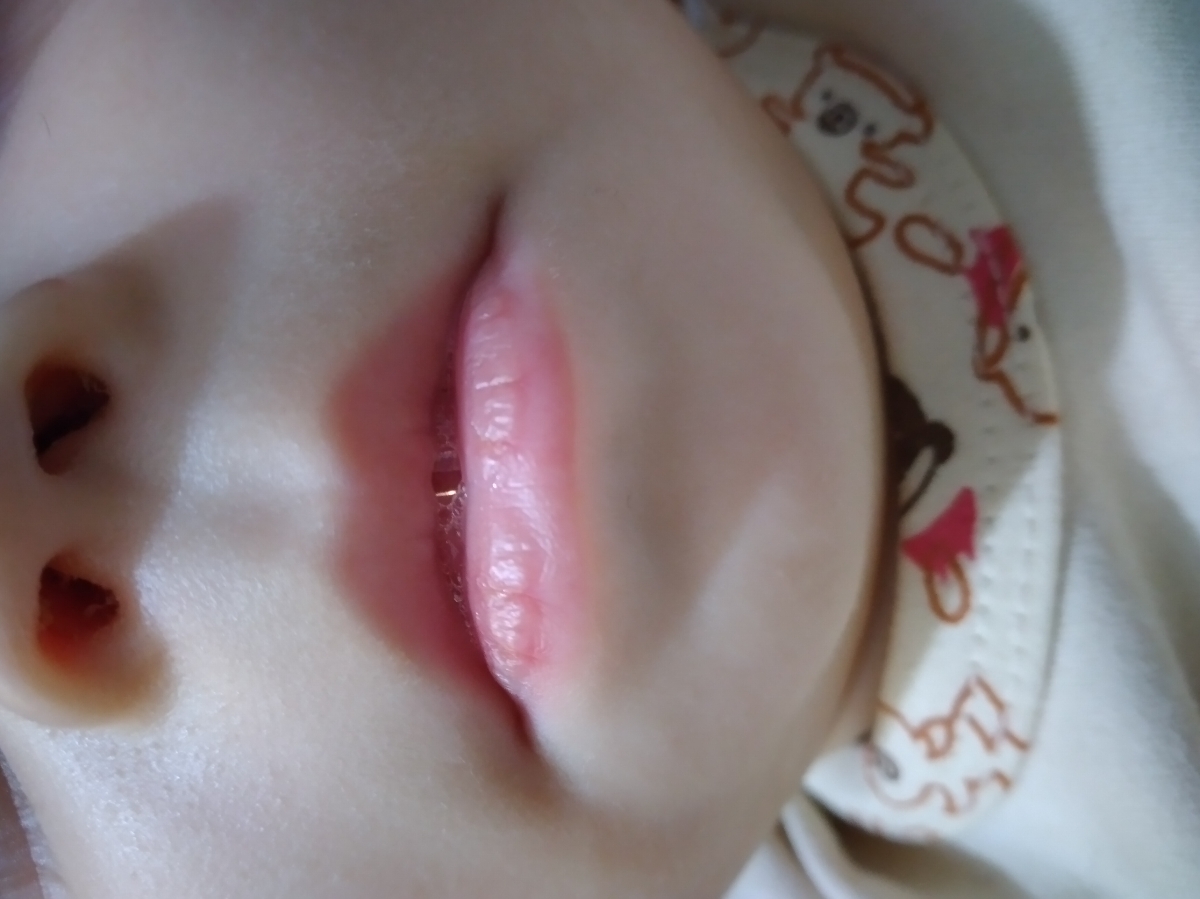 تب و علائم دندان دراوردن