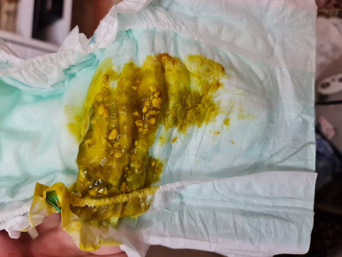 خون در مدفوع نوزاد همراه عکس خون در مدفوع نوزاد همراه عکس