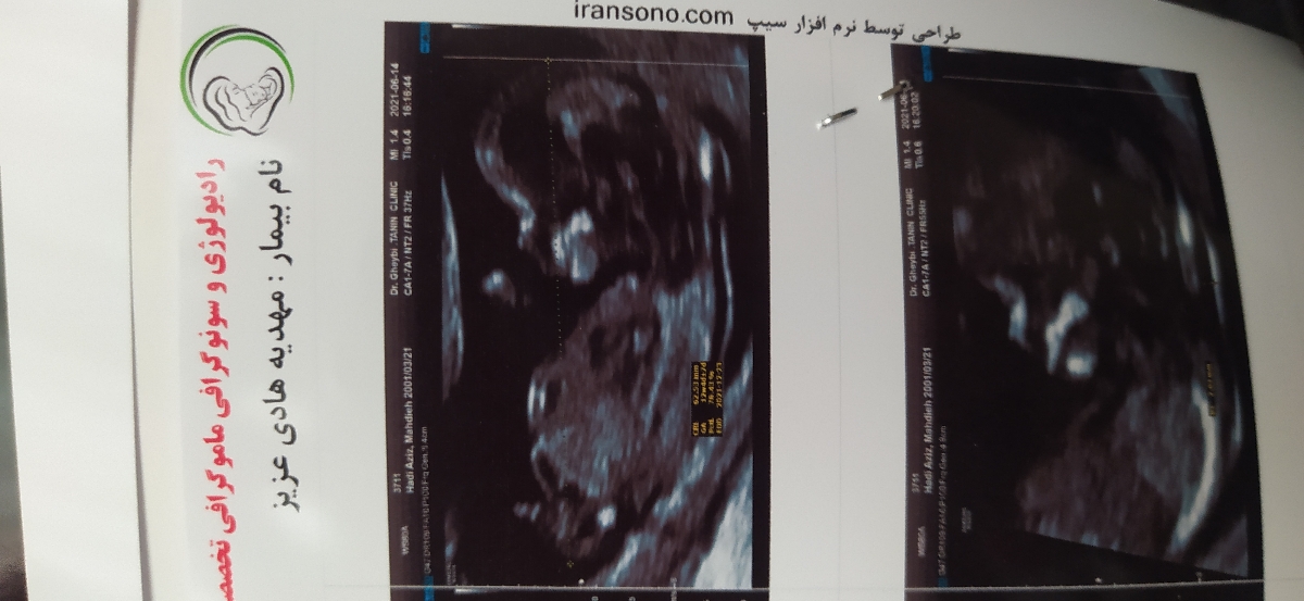 جنسیت تو ۱۲هفتگی قابل تشخیصه یا ن؟