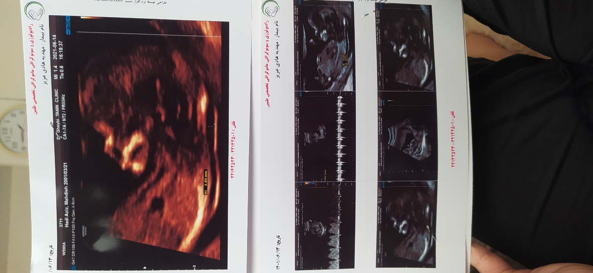 جنسیت تو ۱۲هفتگی قابل تشخیصه یا ن؟