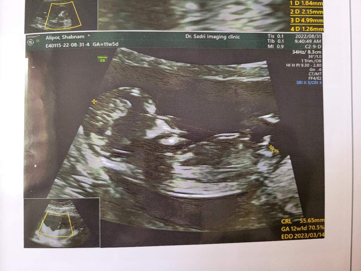 جنسیت تو ۱۲هفتگی قابل تشخیصه یا ن؟