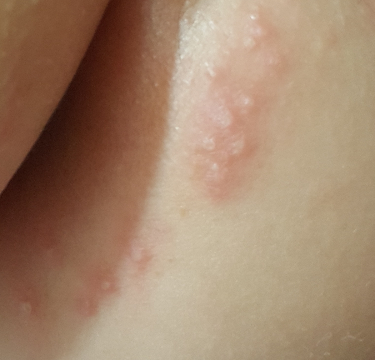 علت جوش های سر سفید کنار مقعد و آلت تناسلی علت جوش های سر سفید کنار مقعد و آلت تناسلی