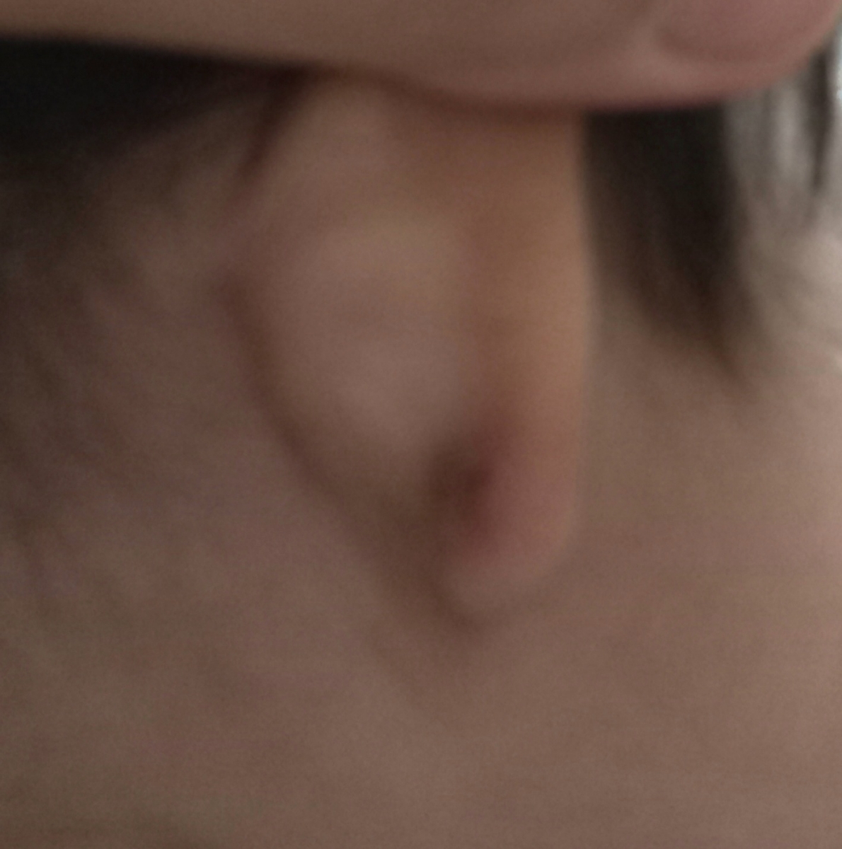 پاره شدن گوش نوزاد پاره شدن گوش نوزاد