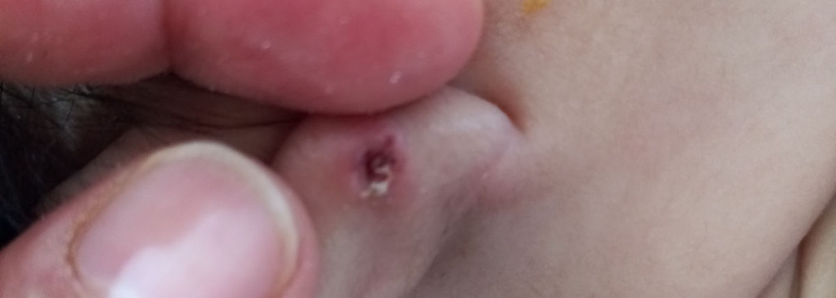 پاره شدن گوش نوزاد پاره شدن گوش نوزاد