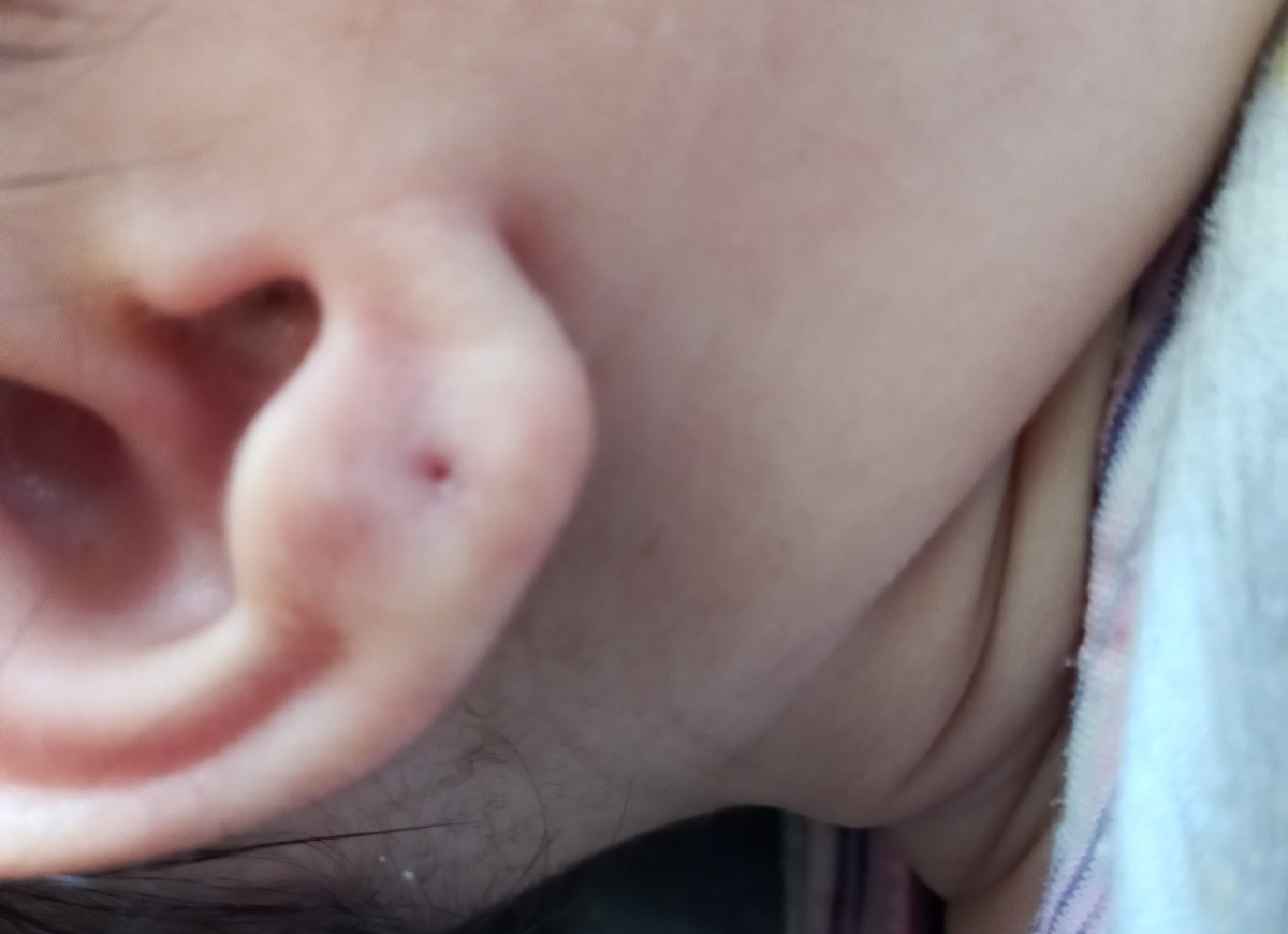 پاره شدن گوش نوزاد پاره شدن گوش نوزاد