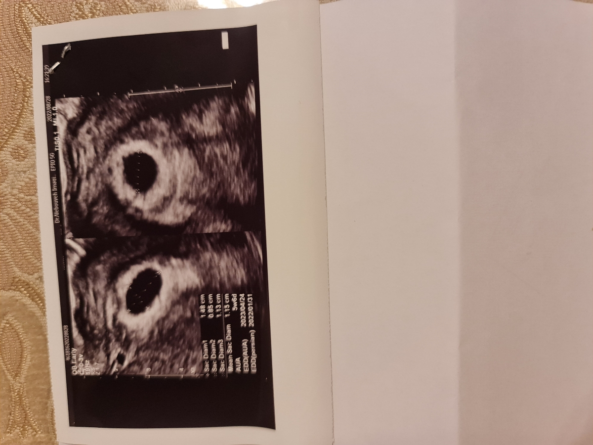 دیده نشدن جنین در ۷ هفتگی