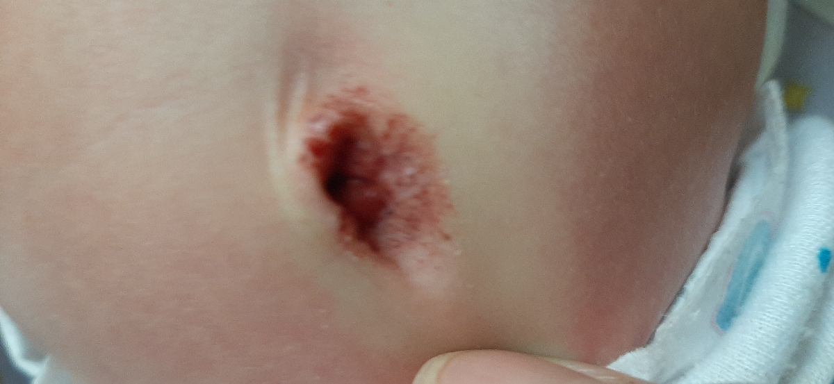 خون آمدن ناف کودک