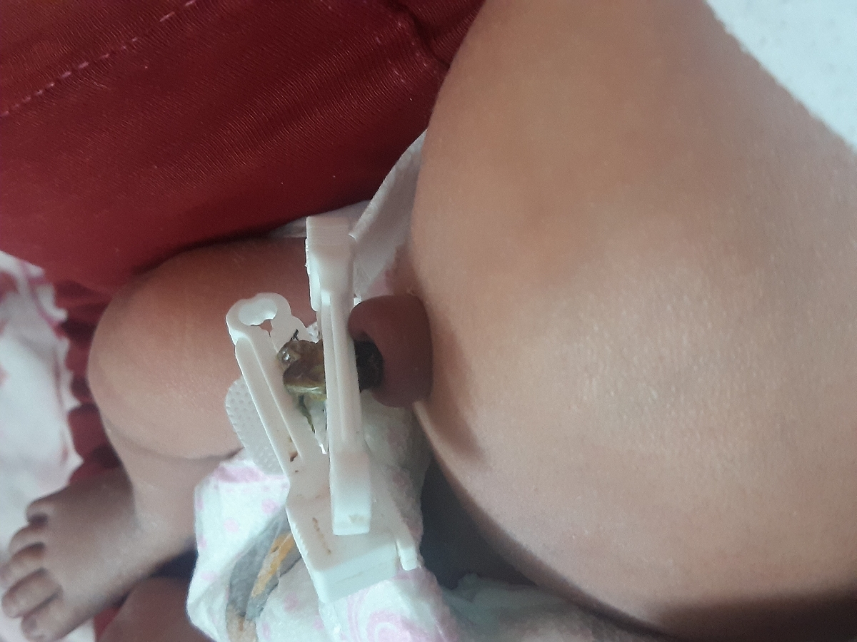 عفونت بند ناف نوزاد