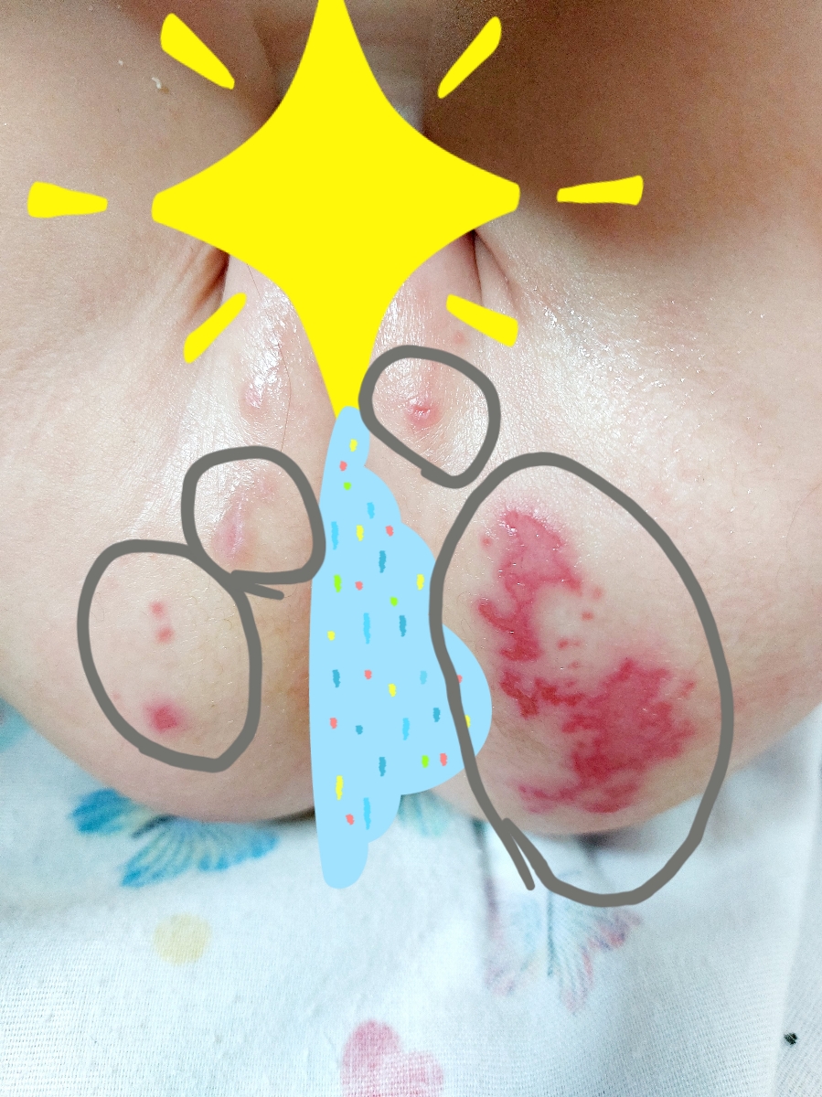 زخم شدن پای بچه