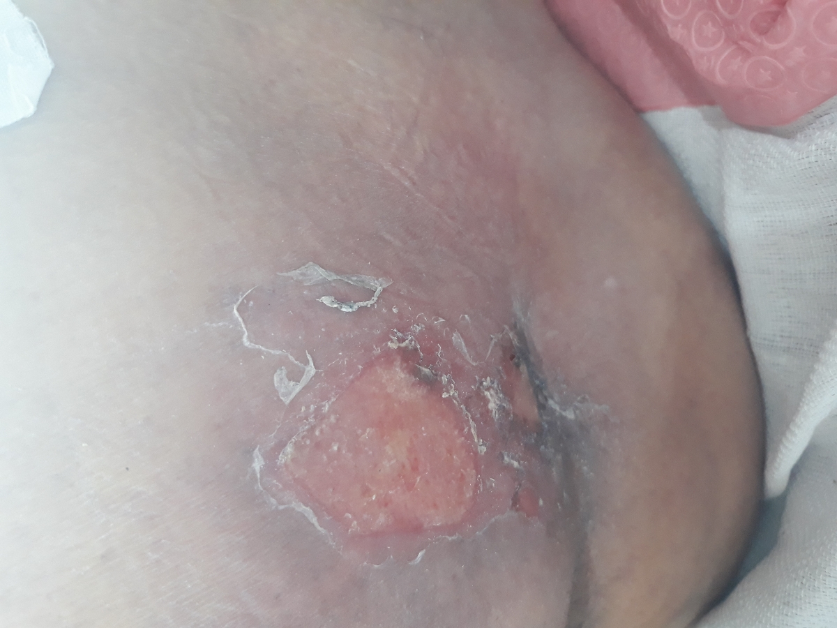 زخم پایین کمر بعد از عمل ران پا