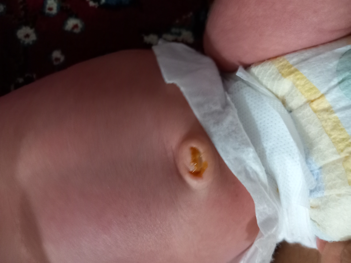 ناف نوزاد بیست روزه