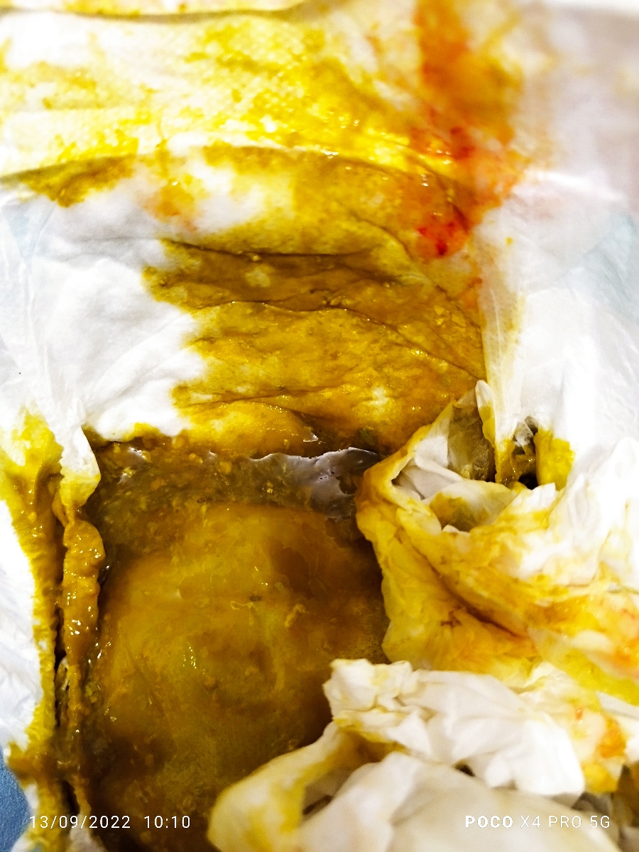 یبوست و خون کودک ۵ماهه