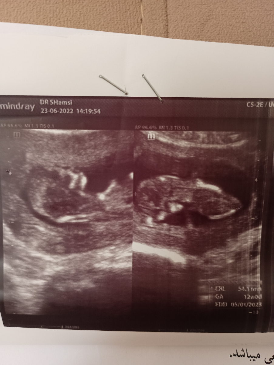 تفسیر آزمایش و سونو NT هفته ۱۲