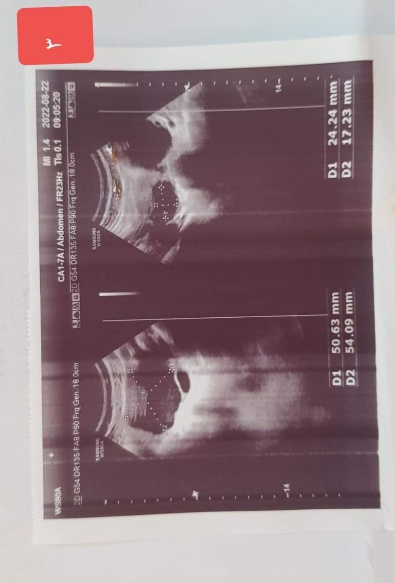 آزمایش تومور مارکر کیست آندومتریوز منو لطفا تفسیر کنید