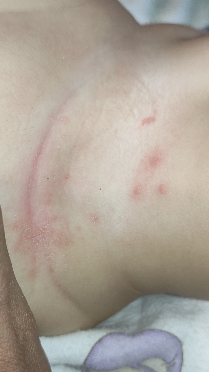 جوش زدن کنار پای نوزاد