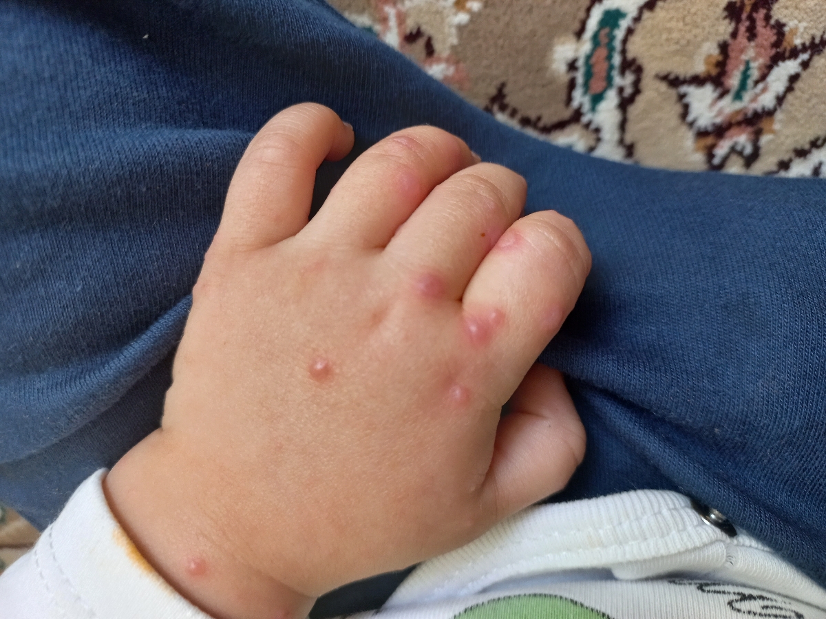 حساسیت کودک ۱ ساله به اموکسی سلین