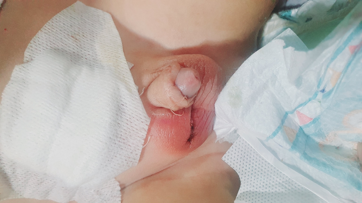 عمل بیضه نوزاد و ورم زیاد ❗❌❌