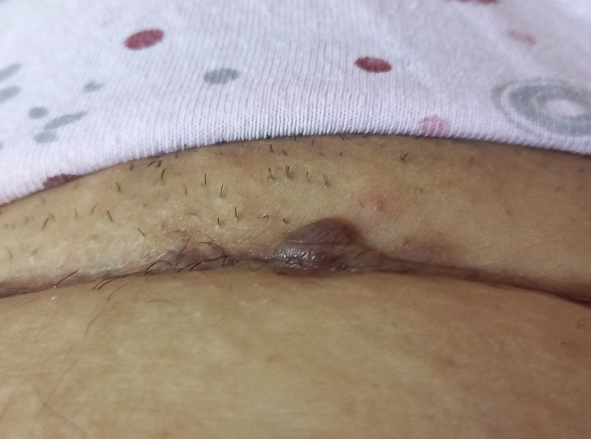 سلام دکتر میشه جای بخیه سزارین منو ببینید