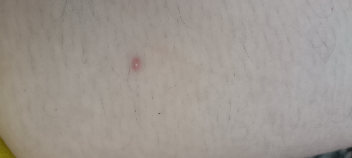 بچه ها این زگیل تناسلیه؟ (عکس) بچه ها این زگیل تناسلیه؟ (عکس)