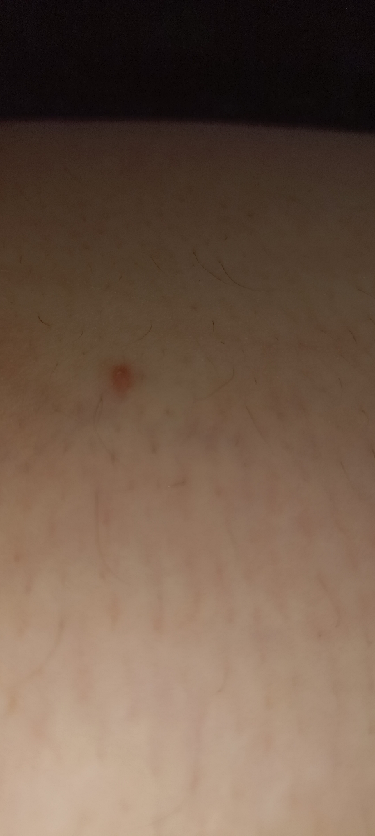 بچه ها این زگیل تناسلیه؟ (عکس) بچه ها این زگیل تناسلیه؟ (عکس)