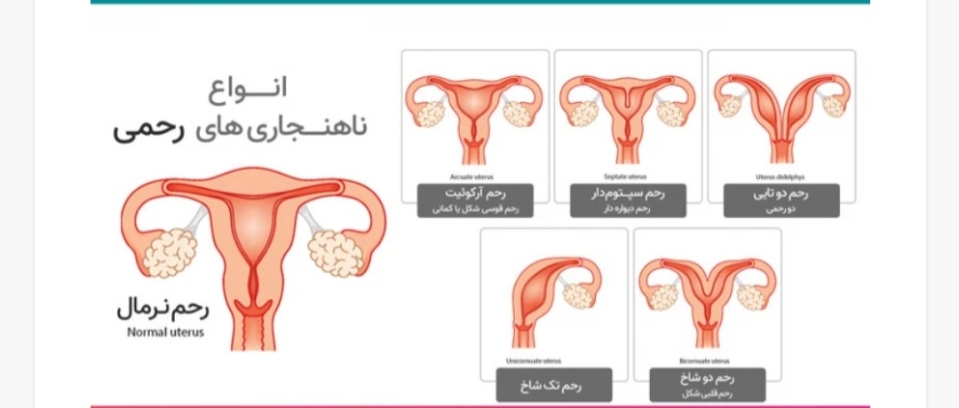 سلام عزیزم ببین با توجه به این عکس هم میفهمیم ک رحم شما به دوشاخ میخوره👆👆👆👆👆