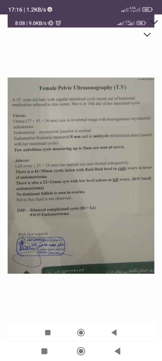 جواب سونوگرافی کیست آندومتریوما با دیواره نازک یعنی چی جواب سونوگرافی کیست آندومتریوما با دیواره نازک یعنی چی