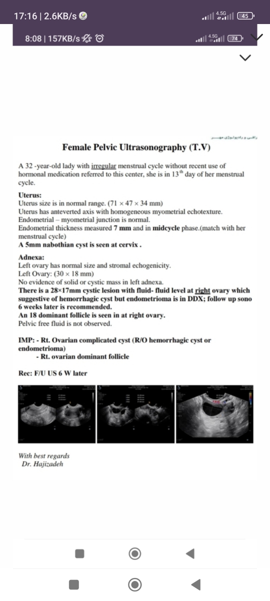 جواب سونوگرافی کیست آندومتریوما با دیواره نازک یعنی چی جواب سونوگرافی کیست آندومتریوما با دیواره نازک یعنی چی