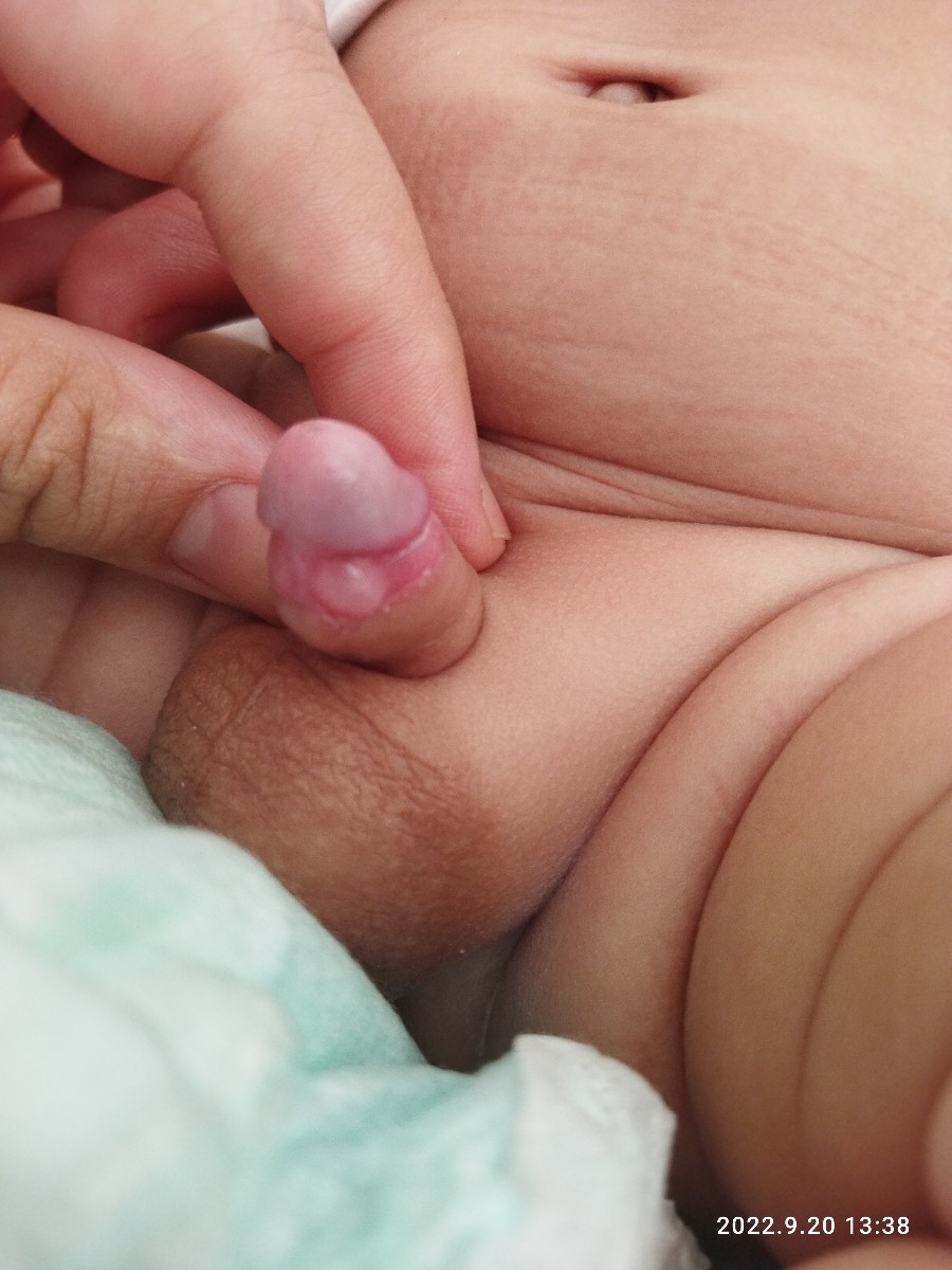 ورم قسمت ختنه نوزاد دوماه و نیم