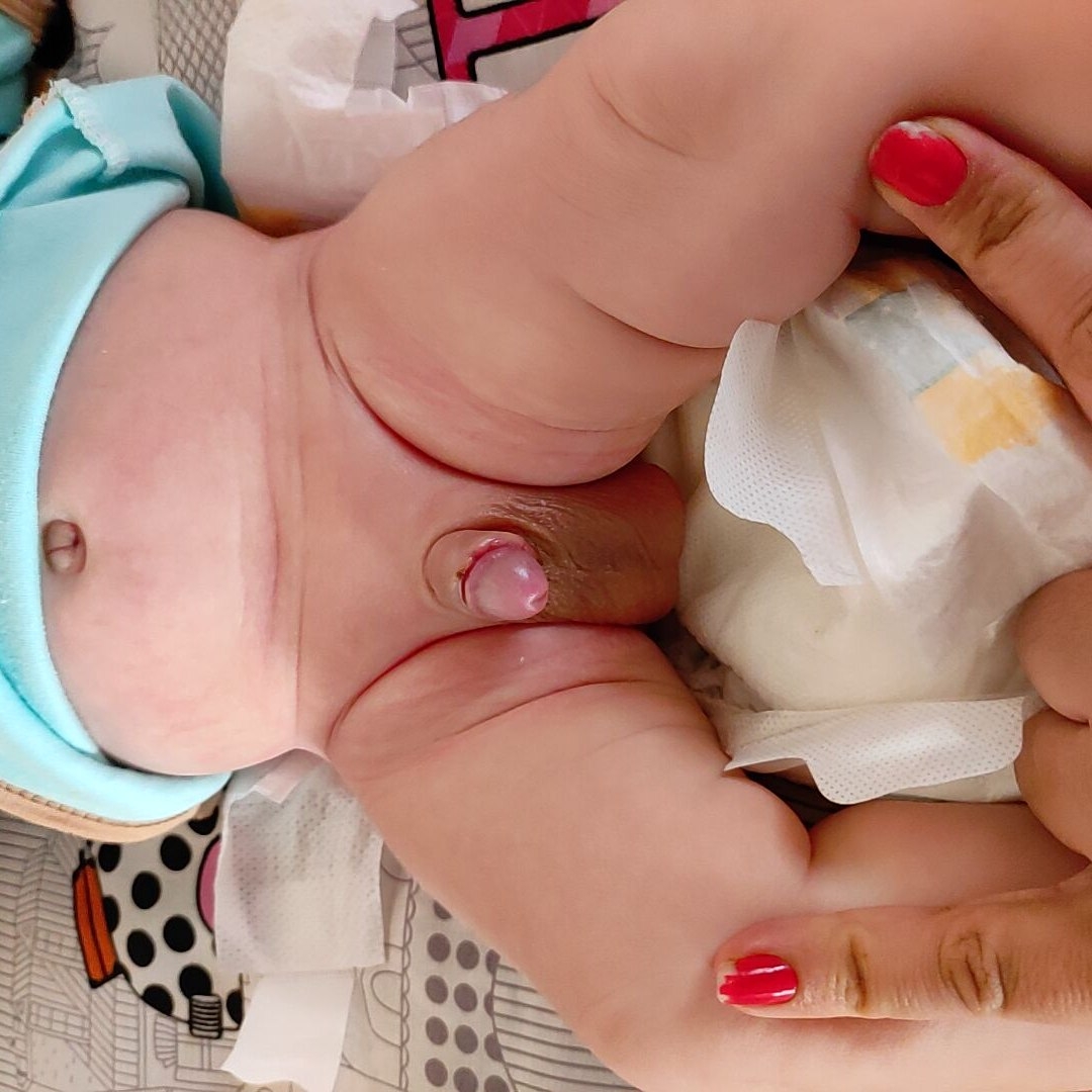 کبود شدن بیضه بعد از ختنه