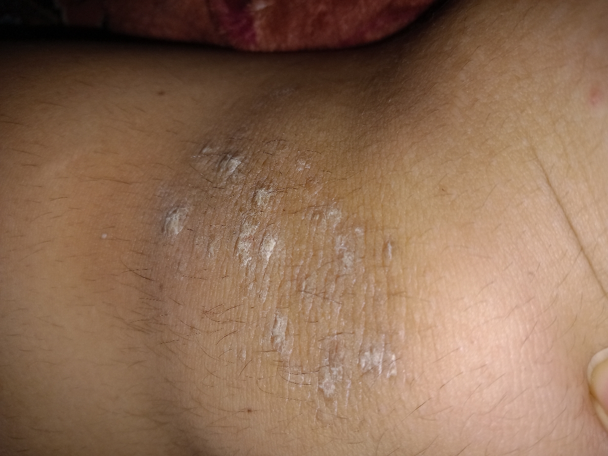 سفیدک آرنج و زانو