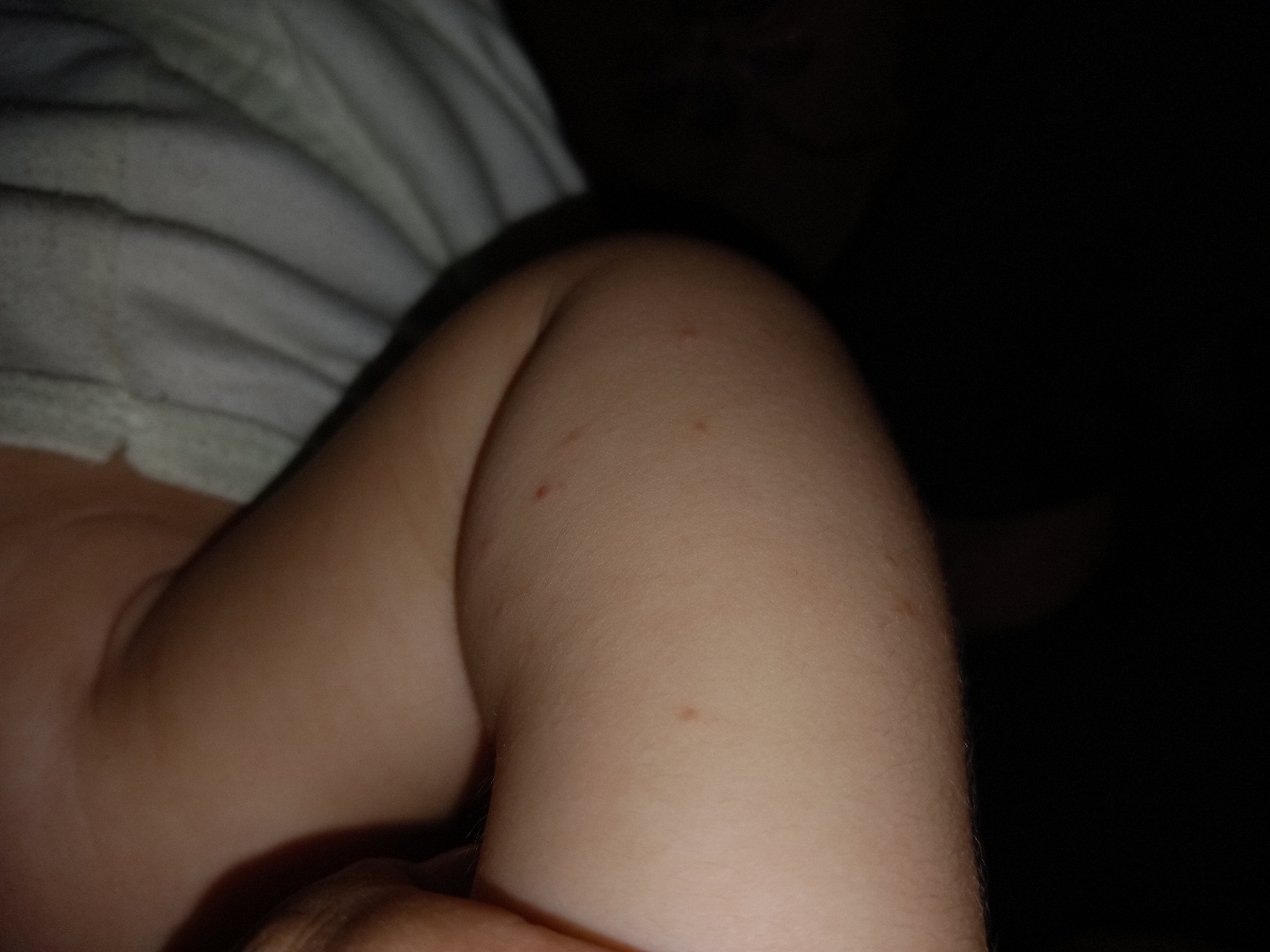 جوش زدن دست. پا نوزاد جوش زدن دست. پا نوزاد