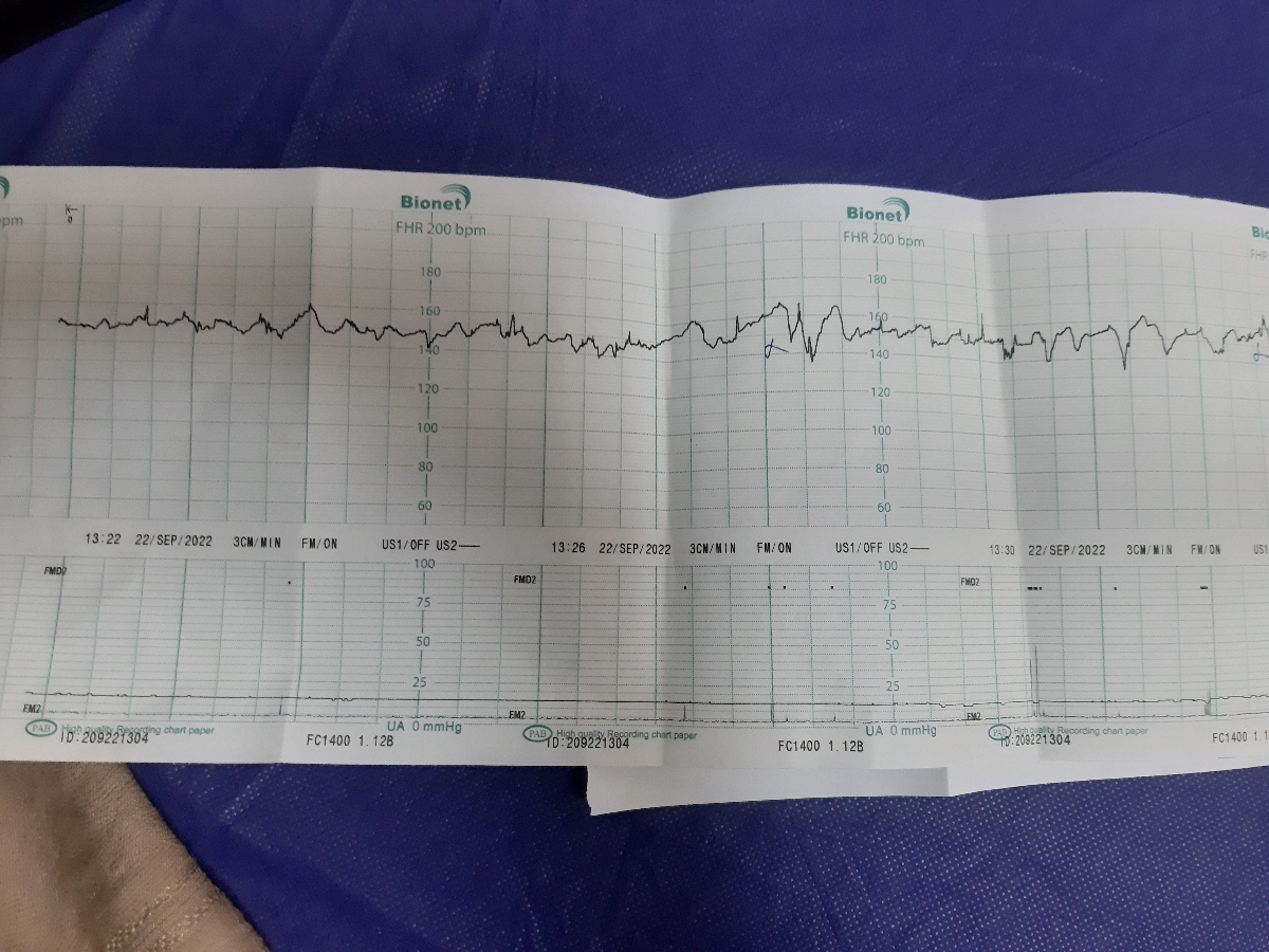نوار قلب جنین امروز در بیمارستان