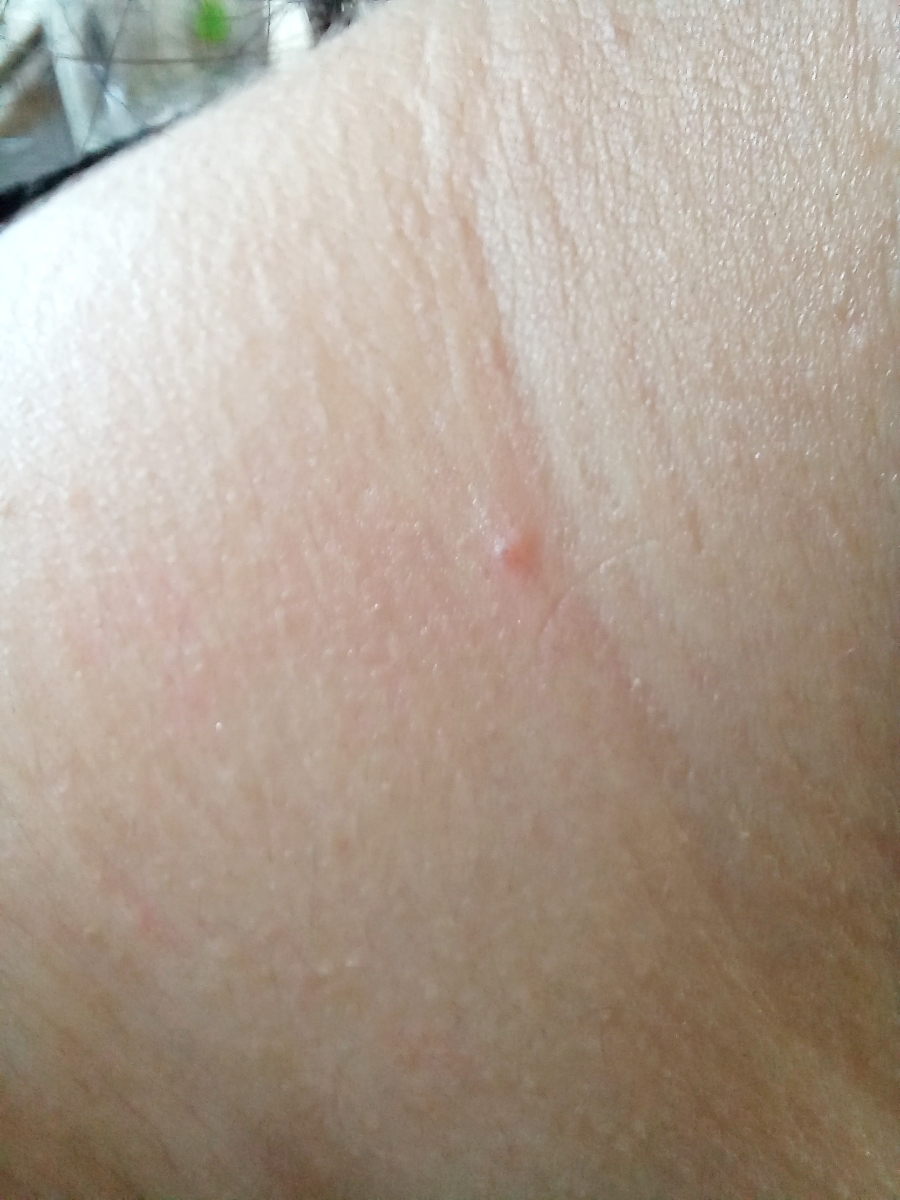 ایا زگیل در گردن واگیر دار هست