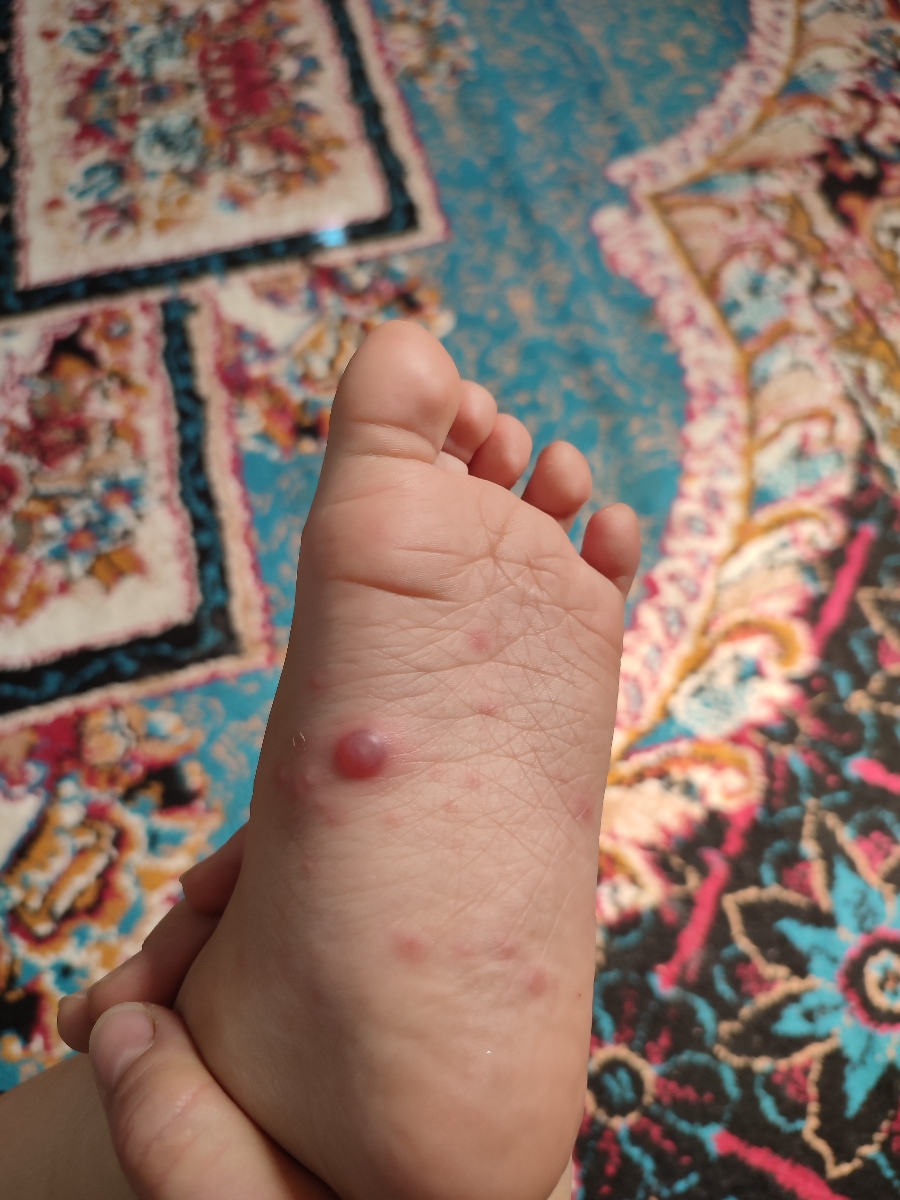اینا آبله مرغانه رو پاها و دور دهان پسرم؟؟دکترش تعطیلع، پزشک عمومی گف آبلس