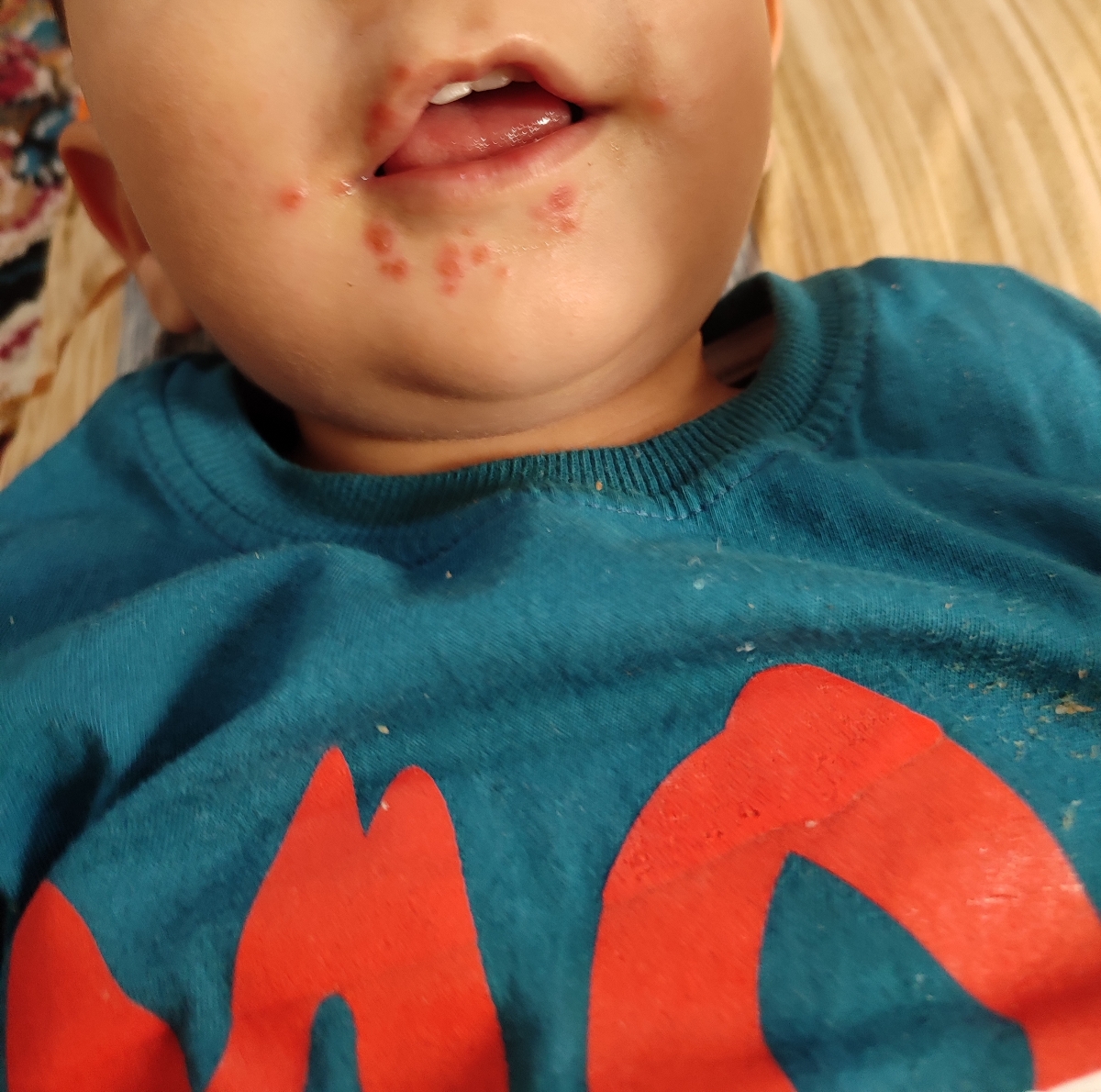 اینا آبله مرغانه رو پاها و دور دهان پسرم؟؟دکترش تعطیلع، پزشک عمومی گف آبلس