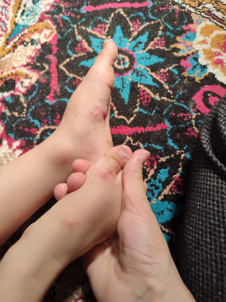 اینا آبله مرغانه رو پاها و دور دهان پسرم؟؟دکترش تعطیلع، پزشک عمومی گف آبلس