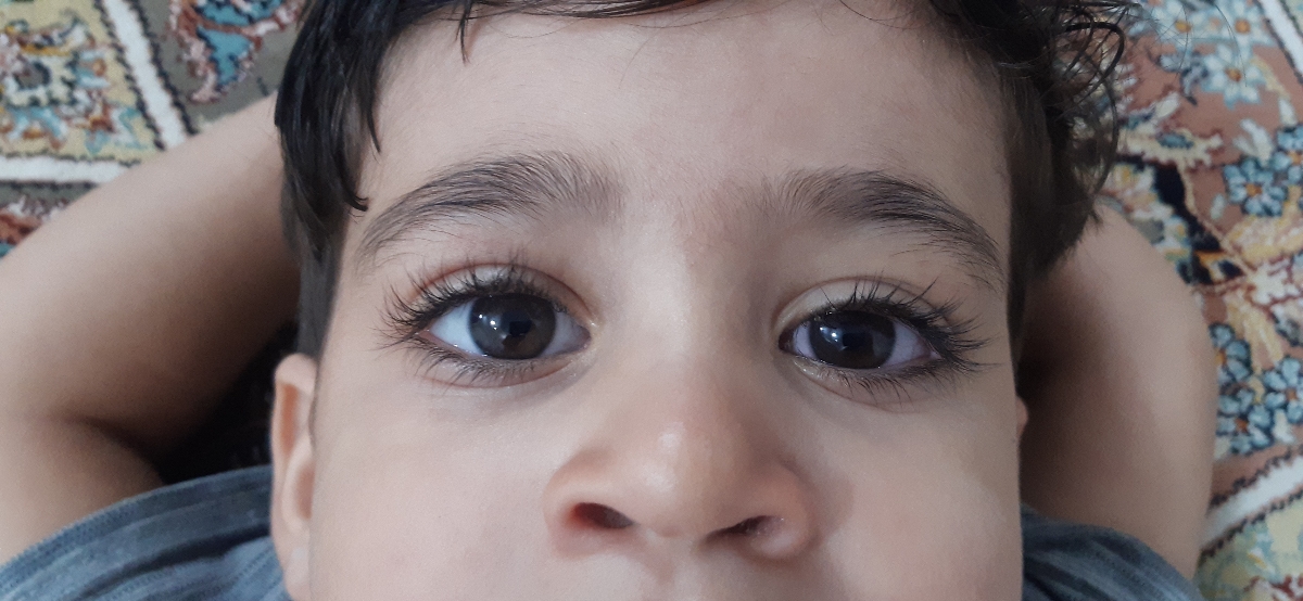 سلام.عفونت و قرمزی چشم کودک