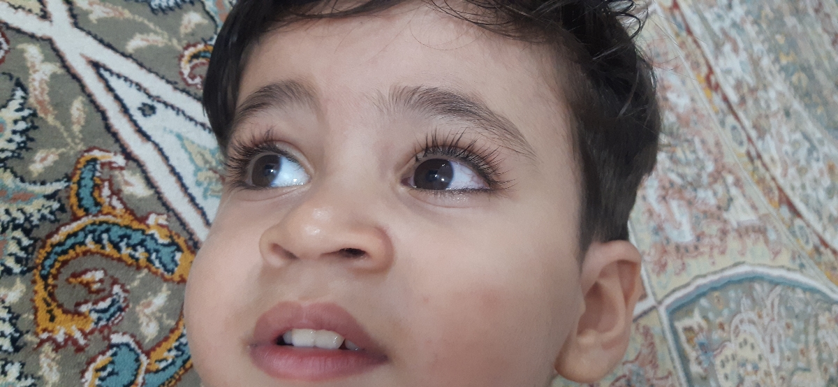 سلام.عفونت و قرمزی چشم کودک