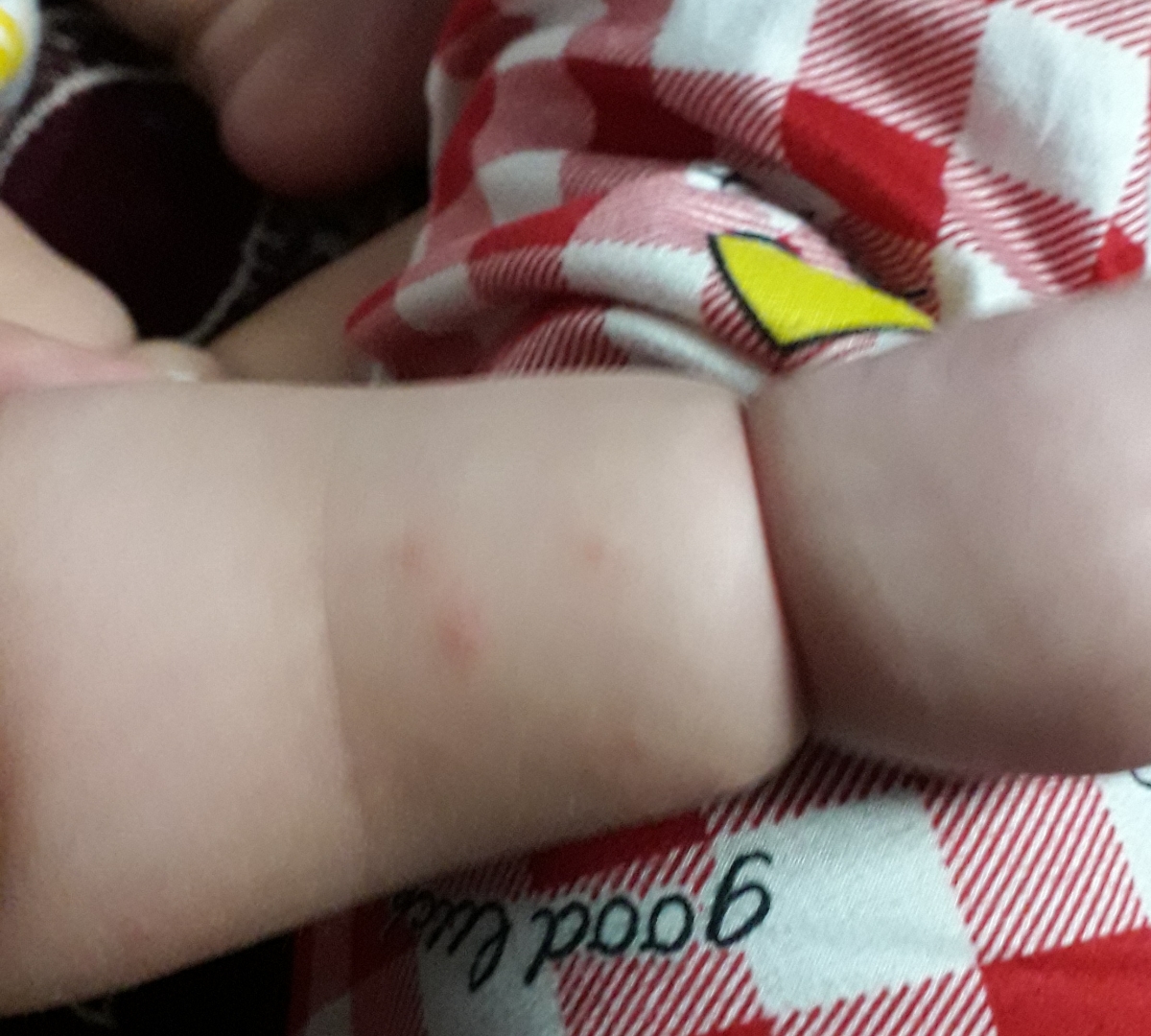 دونه های روی پوست نوزاد۶ماه و۱۲روزه دونه های روی پوست نوزاد۶ماه و۱۲روزه