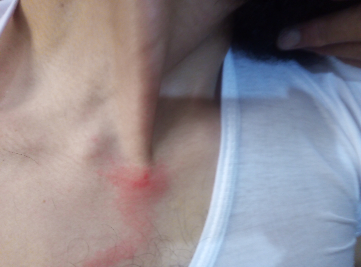 قرمزی روی قفسه سینه