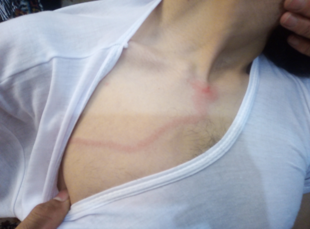 قرمزی روی قفسه سینه