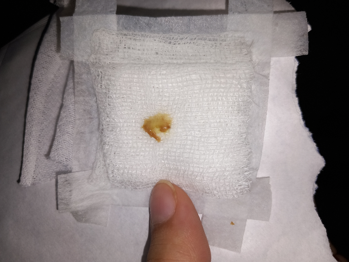 عفونت ناف در یکماهگی عفونت ناف در یکماهگی