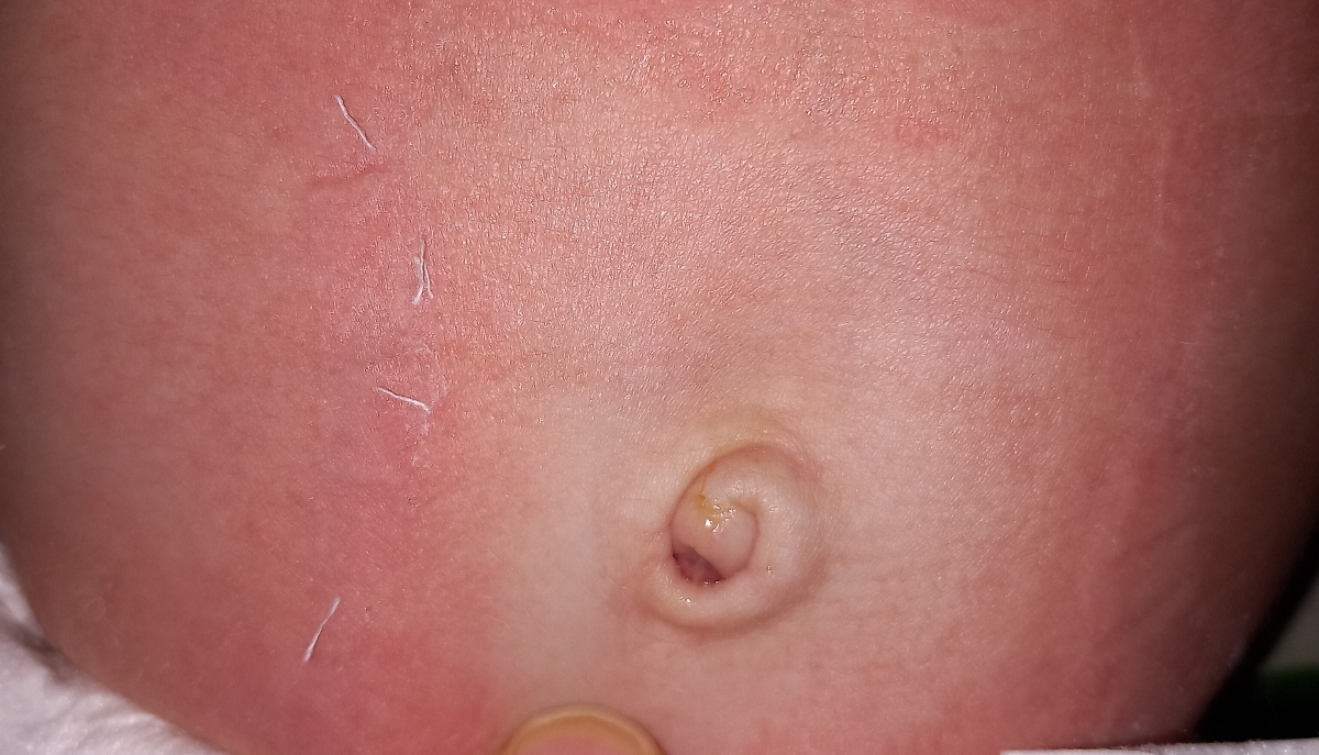 عفونت ناف در یکماهگی عفونت ناف در یکماهگی